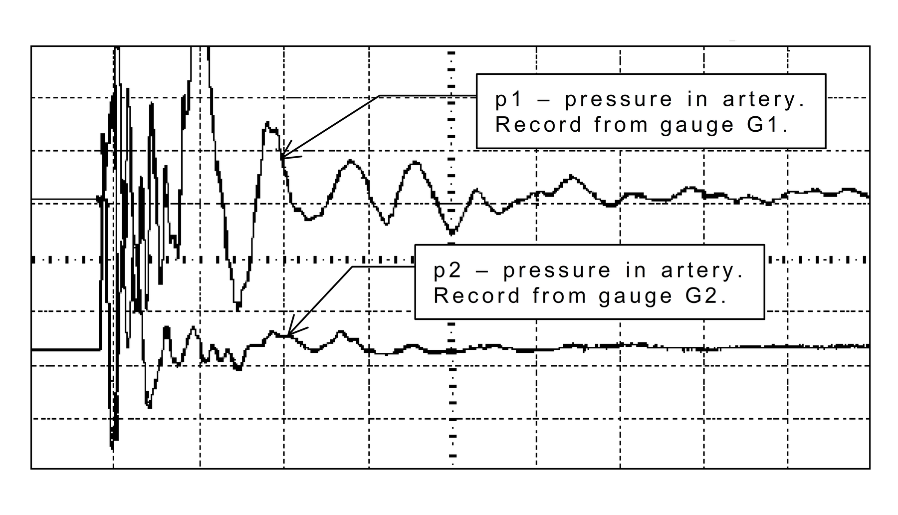 Unscaled pressure-time curves in the artery after penetration of PL sample with FMJ rifle projectile of calibre 7.62 mm.